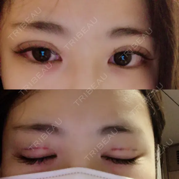 二重埋没 品川美容外科 仙台院 DAY 0 メイン用