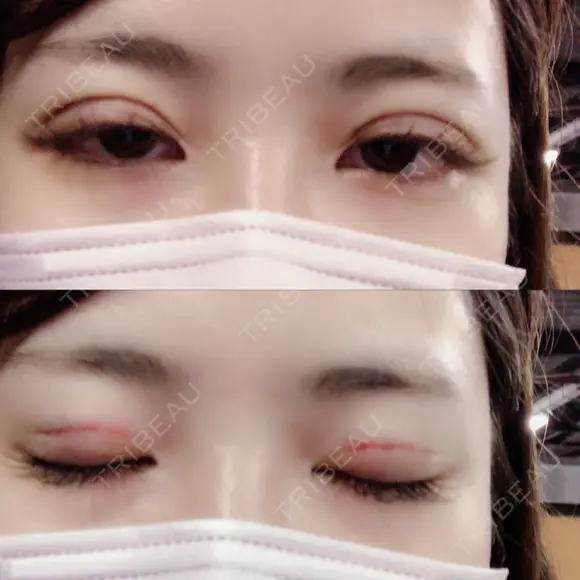 二重埋没 品川美容外科 仙台院 DAY 0 メイン用