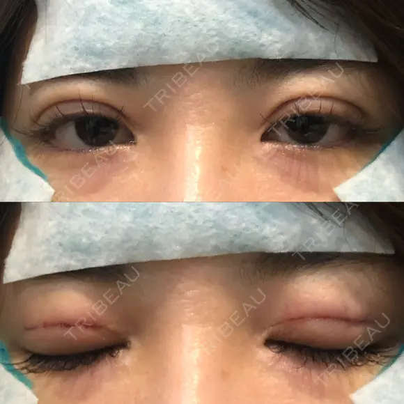 二重埋没 品川美容外科 仙台院 DAY 0 メイン用