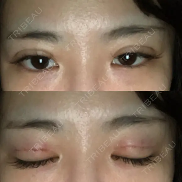 二重埋没 品川美容外科 仙台院 DAY 1 メイン用