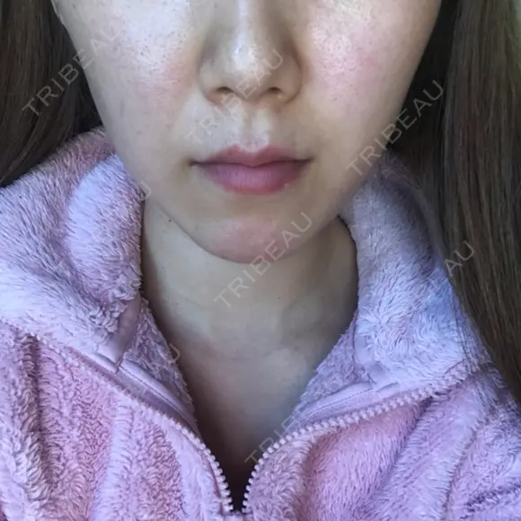 脂肪溶解注射（顔） / その他（肌） The-Clim産婦人科  DAY 4 メイン用