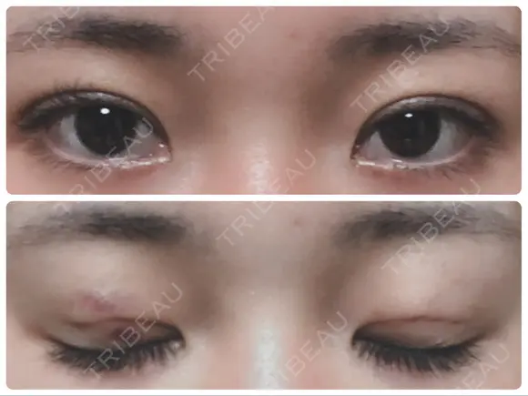 二重埋没 城本クリニック 姫路院 DAY 2 メイン用