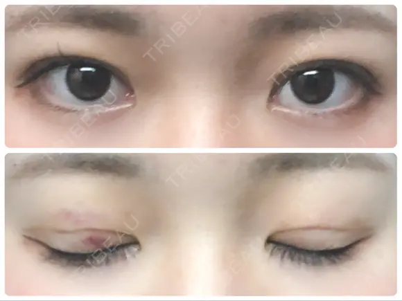 二重埋没 城本クリニック 姫路院 DAY 3 メイン用