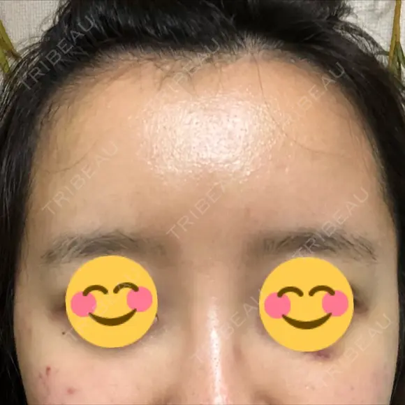 額を丸く / 脂肪注入（額） / 再生医療 / PRP皮膚再生療法 エートップ美容整形外科 DAY 9 メイン用