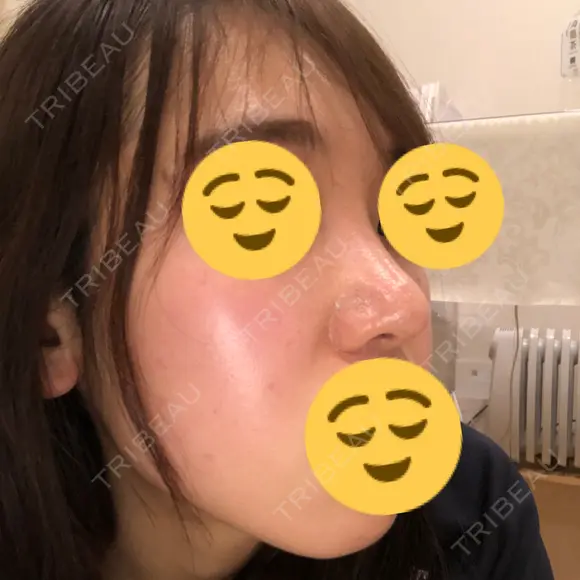 鼻尖形成（切開） / 鼻中隔延長（切開） / 小鼻縮小（切開） / 軟骨移植 / 骨切幅寄せ HANABI整形外科 DAY 211 メイン用