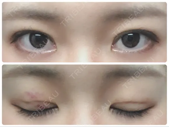 二重埋没 城本クリニック 姫路院 DAY 4 メイン用