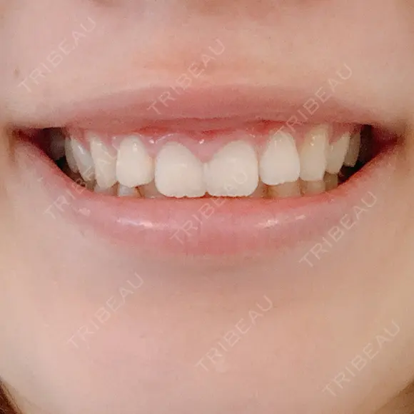 ガミースマイル手術 / その他（口元） 美容皮膚科ピュアビューティー恵比寿 AFTER メイン用