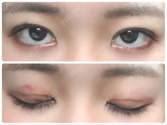 二重埋没 城本クリニック 姫路院 DAY 5 メイン用