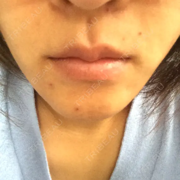 脂肪溶解注射（顔） あらなみクリニック 千葉院 DAY 1 メイン用