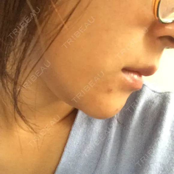 脂肪溶解注射（顔） あらなみクリニック 千葉院 DAY 1 メイン用