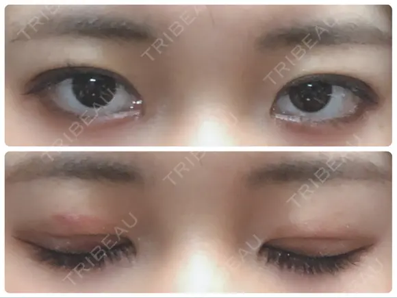 二重埋没 城本クリニック 姫路院 DAY 6 メイン用