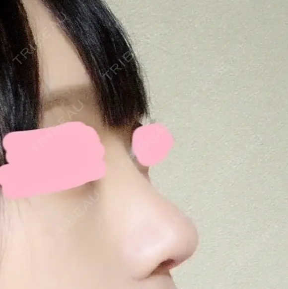 鼻尖形成（切開） / 小鼻縮小（切開） / 軟骨移植 / 骨切幅寄せ HANABI整形外科 DAY 32 メイン用