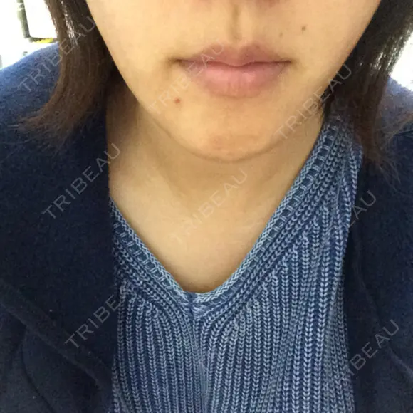 脂肪溶解注射（顔） あらなみクリニック 千葉院 AFTER メイン用