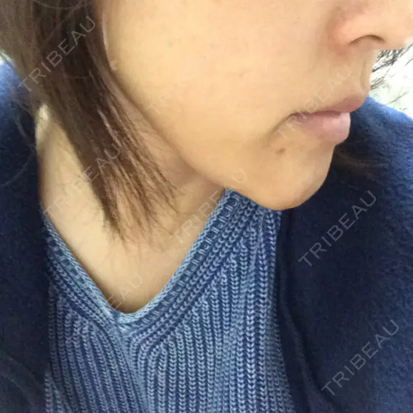 脂肪溶解注射（顔） あらなみクリニック 千葉院 DAY 2 メイン用