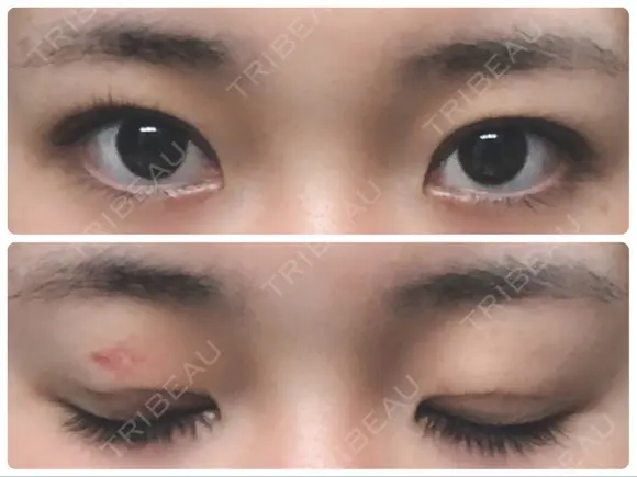 二重埋没 城本クリニック 姫路院 DAY 7 メイン用