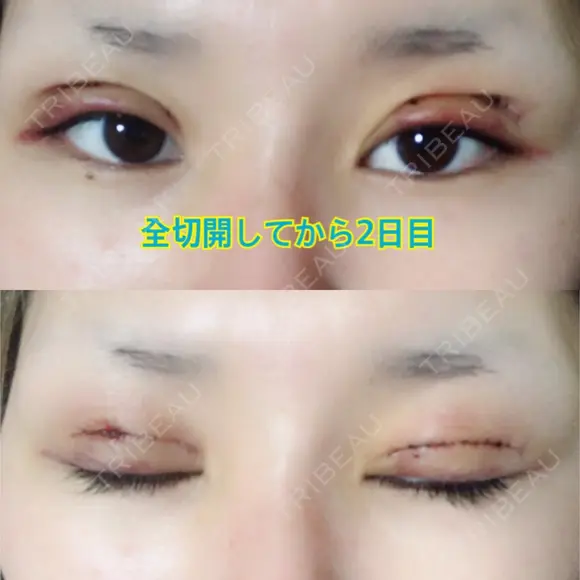 二重切開 GLANZ CLINIC DAY 1 メイン用