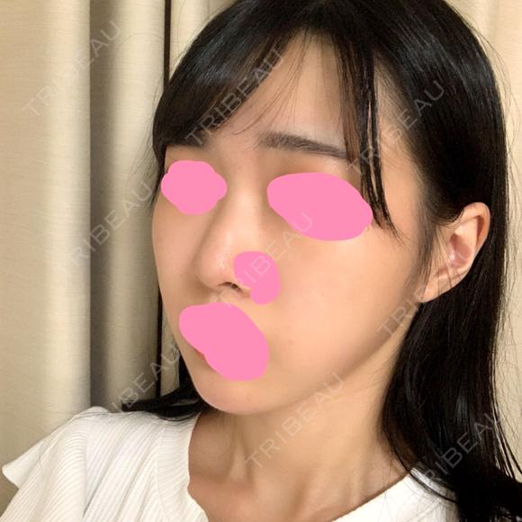 脂肪吸引（顔） / ボトックス（あご） / ヒアルロン酸注入（あご） / ボトックス（エラ・小顔） プチパーティー医院 DAY 89 メイン用