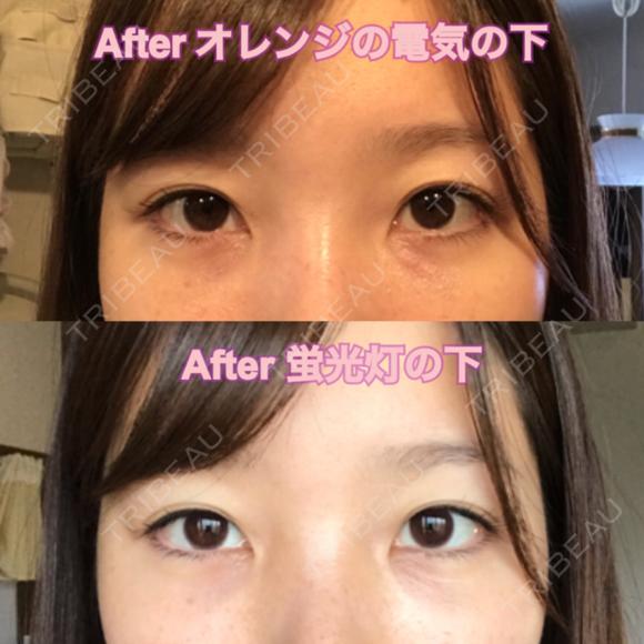 クマ治療 / 下まぶたたるみ取り / 下まぶたの脂肪取り セオリークリニック DAY 38 メイン用