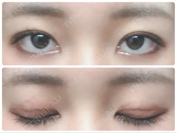 二重埋没 城本クリニック 姫路院 DAY 8 メイン用