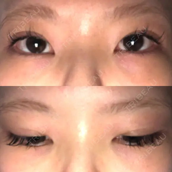 二重埋没 / 下まぶたの脂肪取り / ボトックス（エラ・小顔） 表参道スキンクリニック 表参道院 AFTER メイン用