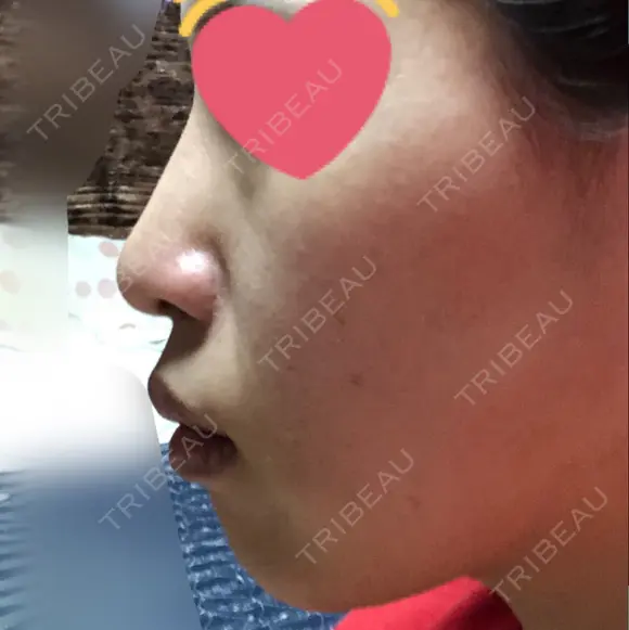 鼻尖形成（切開） / 軟骨移植 湘南美容クリニック 高松院 DAY 90 メイン用