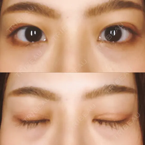 二重埋没 藤・ナチュレ美容クリニック 恵比寿院 DAY 18 メイン用