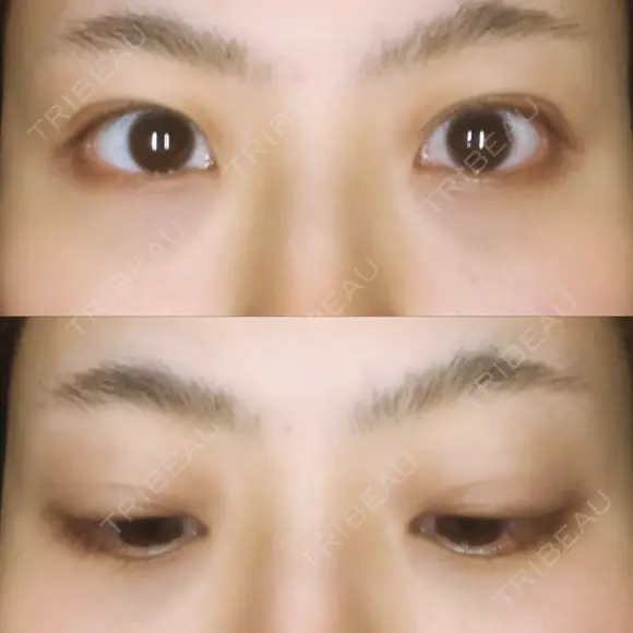 二重埋没 藤・ナチュレ美容クリニック 恵比寿院 DAY 18 メイン用