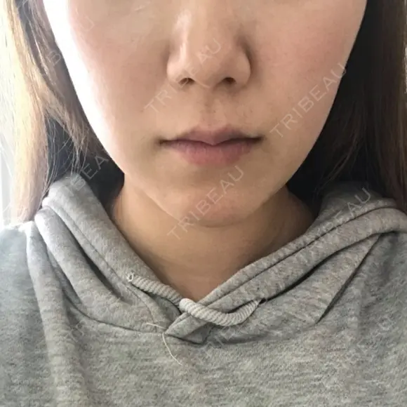 脂肪溶解注射（顔） / その他（肌） The-Clim産婦人科  DAY 8 メイン用