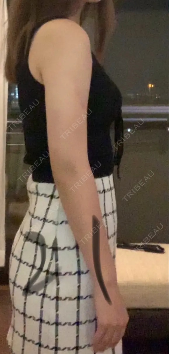 脂肪吸引（二の腕） プチパーティー医院 DAY 21 メイン用