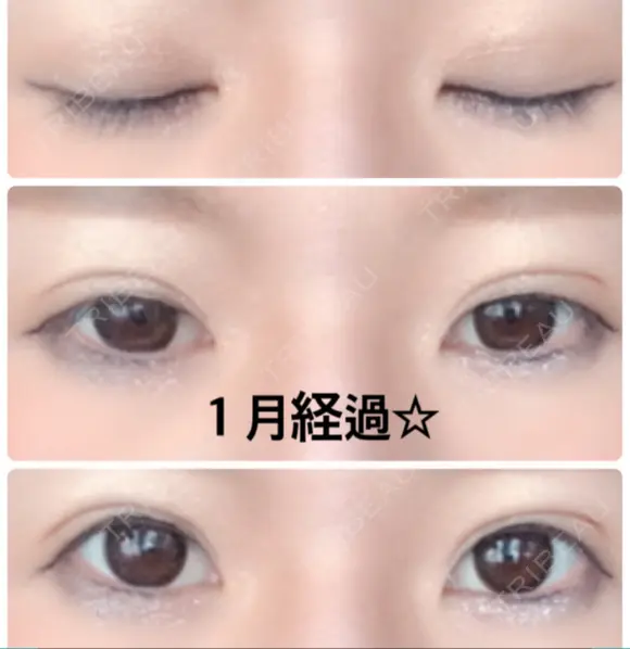 二重埋没 城本クリニック 姫路院 DAY 34 メイン用