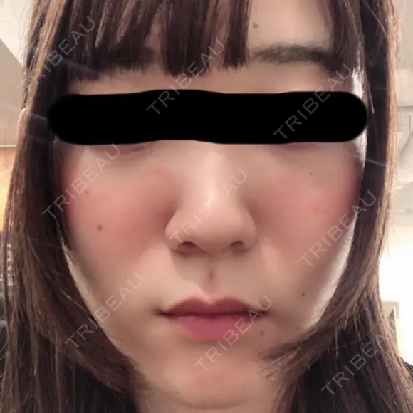 ニキビ治療 石井クリニック 青山サロン AFTER メイン用