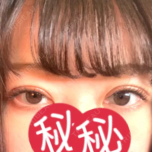 眼瞼下垂（切開） 札幌中央形成外科 DAY 35 メイン用