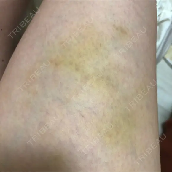 額を丸く / 脂肪注入（額） / 再生医療 / PRP皮膚再生療法 エートップ美容整形外科 DAY 10 メイン用