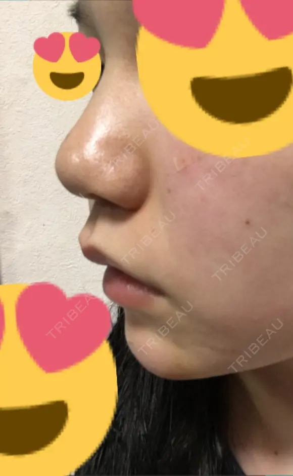 スレッドノーズ リエンジャン整形外科 江南店 DAY 8 メイン用