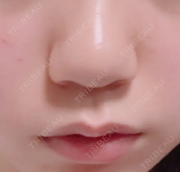 スレッドノーズ リエンジャン整形外科 江南店 DAY 8 メイン用