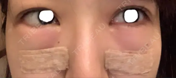 クマ治療 / 下まぶたの脂肪取り ララ整形外科 DAY 0 メイン用