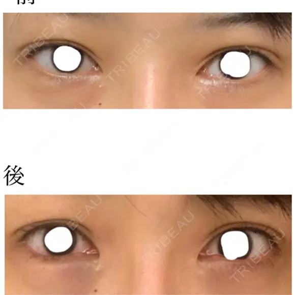 クマ治療 / 下まぶたの脂肪取り ララ整形外科 DAY 0 メイン用