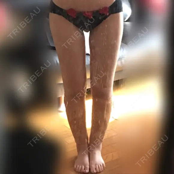 ボトックス（ふくらはぎ） / その他（ボディ） プチパーティー医院 DAY 22 メイン用