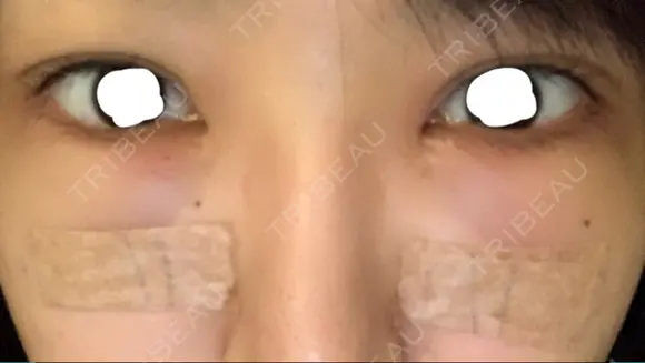 クマ治療 / 下まぶたの脂肪取り ララ整形外科 AFTER メイン用