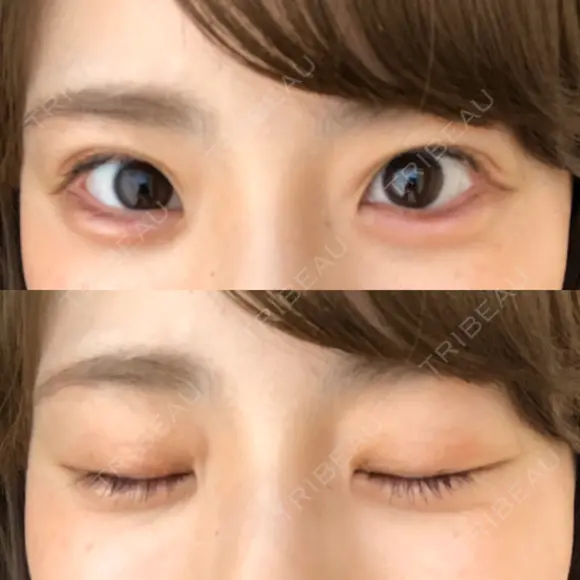 ヒアルロン酸注入（涙袋） 湘南美容クリニック 岐阜院 DAY 1 メイン用