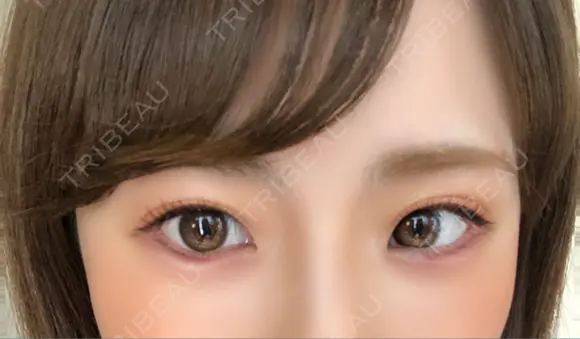 ヒアルロン酸注入（涙袋） 湘南美容クリニック 岐阜院 DAY 1 メイン用