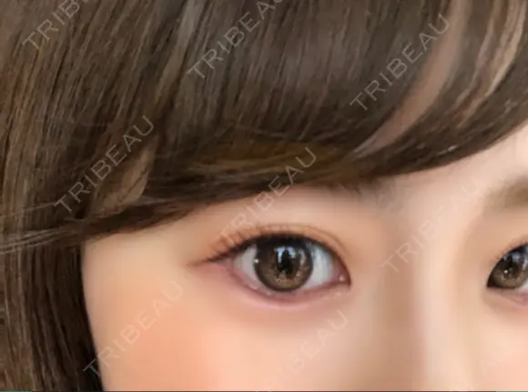 ヒアルロン酸注入（涙袋） 湘南美容クリニック 岐阜院 DAY 1 メイン用