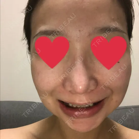 セットバック リッツ美容外科 東京院 DAY 6 メイン用