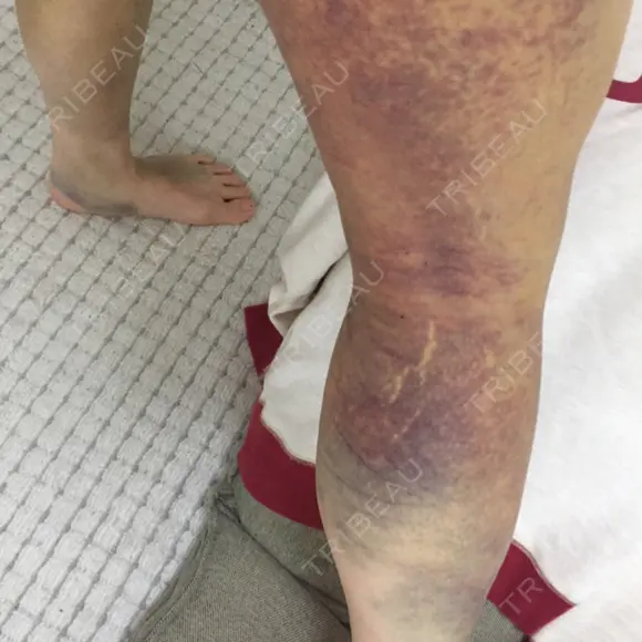 脂肪吸引（脚） / 肌ヒアルロン酸注入（たるみ・シワ改善） プチパーティー医院 DAY 7 メイン用