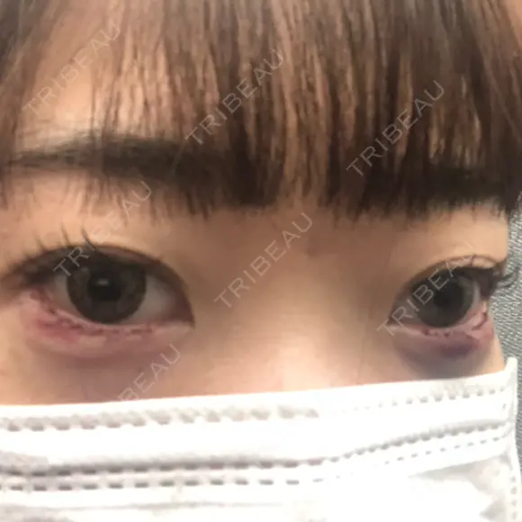 その他（目元） コムロクリニック 東京銀座院 DAY 0 メイン用