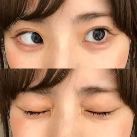 ヒアルロン酸注入（涙袋） 湘南美容クリニック 岐阜院 DAY 2 メイン用