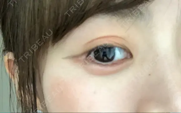 ヒアルロン酸注入（涙袋） 湘南美容クリニック 岐阜院 DAY 2 メイン用