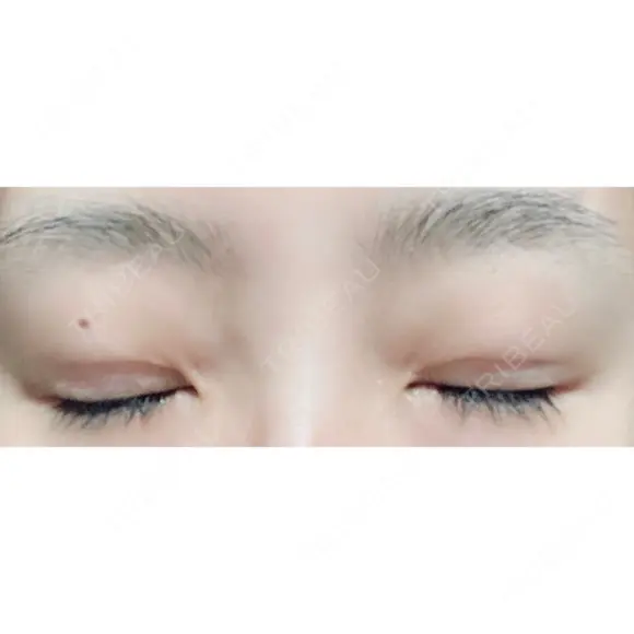 二重埋没 城本クリニック 姫路院 DAY 32 メイン用