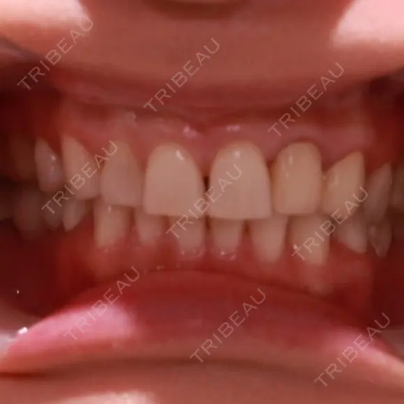 矯正（ワイヤー） / セラミック 東京美容外科 赤坂院 AFTER メイン用