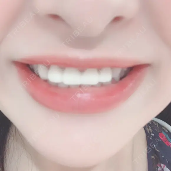 矯正（ワイヤー） / セラミック 東京美容外科 赤坂院 AFTER メイン用